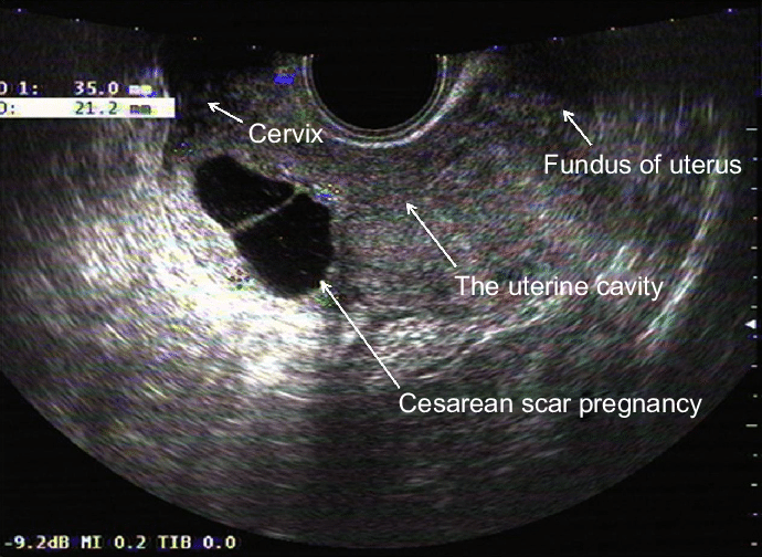 Pelvic Scan / Gynae Scan